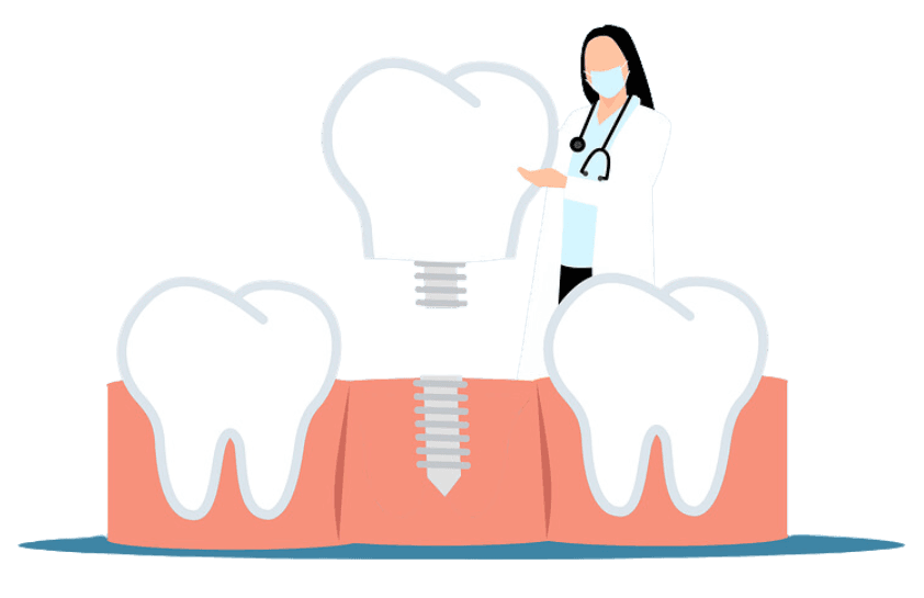 Implant Supported Dentures