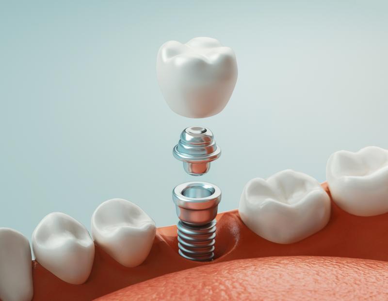 Implant Supported Dentures